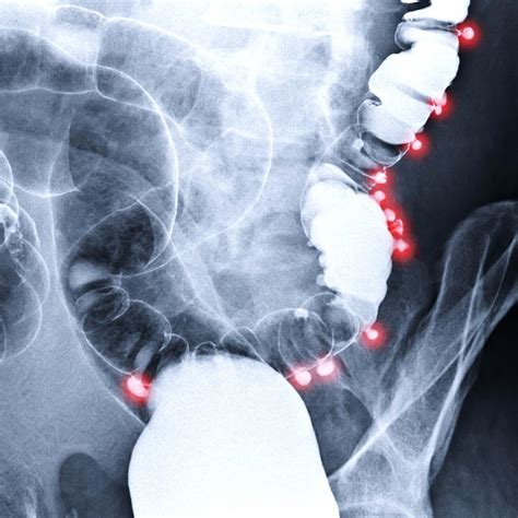 gpnotebook diverticulitis.